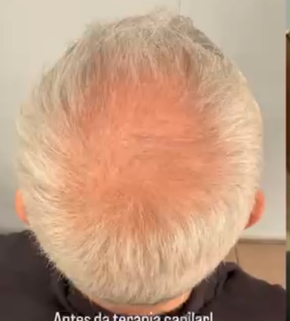 Antes do tratamento — 1 ANO DE TRATAMENTO COM A LINHA DNA VITAL